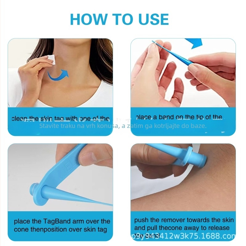 Olovka za uklanjanje bradavica i kožnih izraslina - Podrijetlo Guangdong, Neto sadržaj 50, Pakiranje 200 kom., Rok trajanja 3 godine