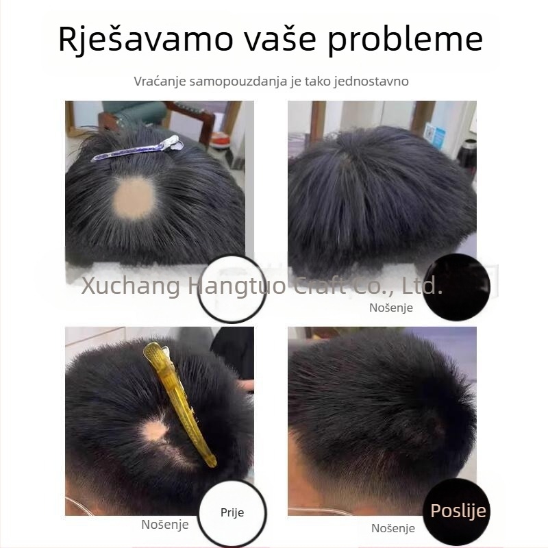 Biološki flaster za ožiljke na vlasištu – ljudska kosa, ručna izrada, može se bojiti