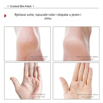 Prozračni flasteri za suhe ispucale ruke i stopala, dišući, pojedinačno pakirani