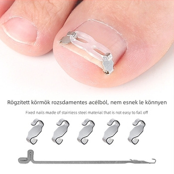 Ortopédiai eszköz benőtt körmökhöz, húzótapasszal a benőtt körmök korrekciójához