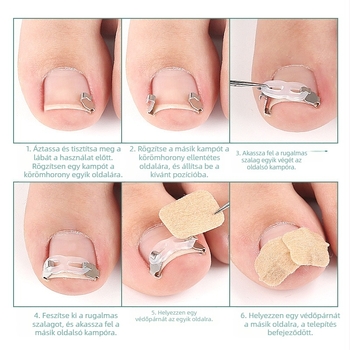 Ortopédiai eszköz benőtt körmökhöz, húzótapasszal a benőtt körmök korrekciójához