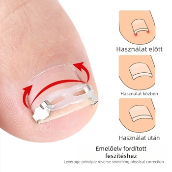 Ortopédiai eszköz benőtt körmökhöz, húzótapasszal a benőtt körmök korrekciójához
