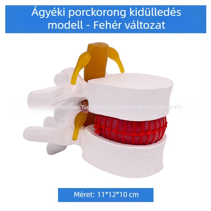 Lumbális gerinc modell orvosi képzéshez – porckorong-kompresszió bemutatása és a gerinccsont patológiája.