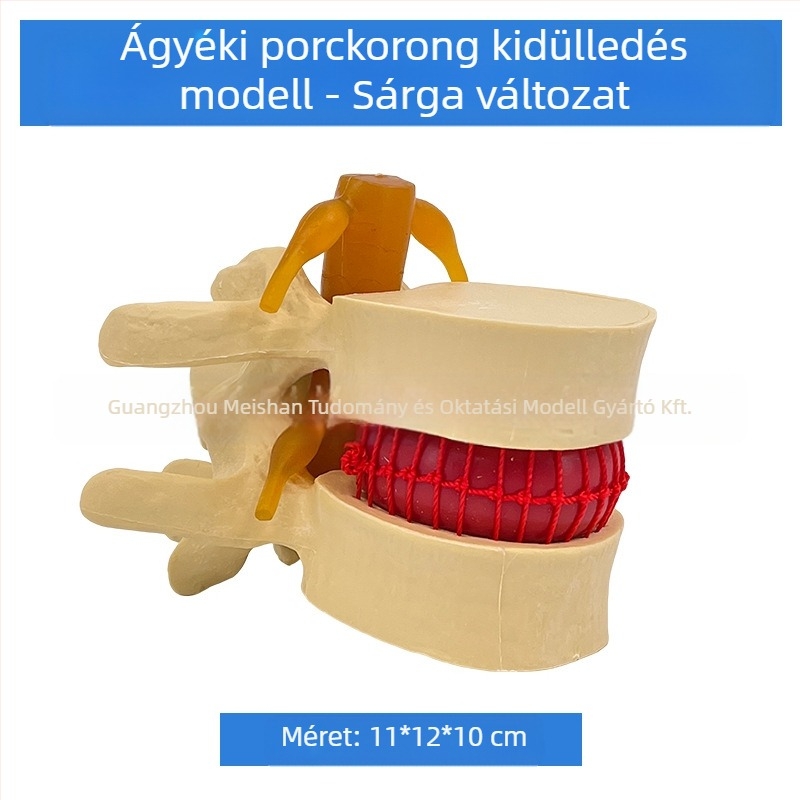 Lumbális gerinc modell orvosi képzéshez – porckorong-kompresszió bemutatása és a gerinccsont patológiája.