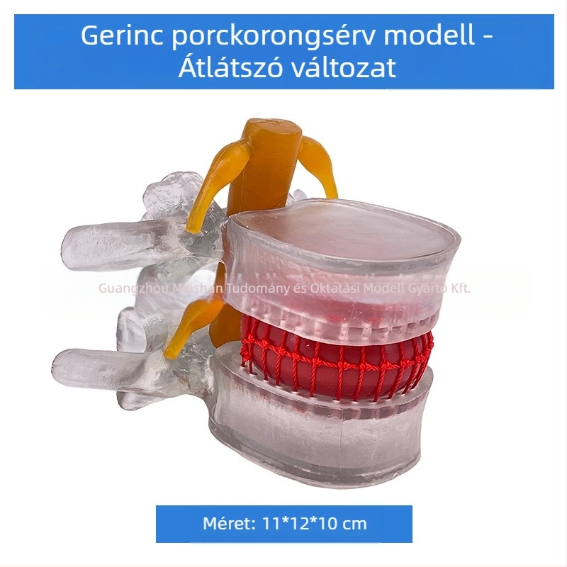 Lumbális gerinc modell orvosi képzéshez – porckorong-kompresszió bemutatása és a gerinccsont patológiája.