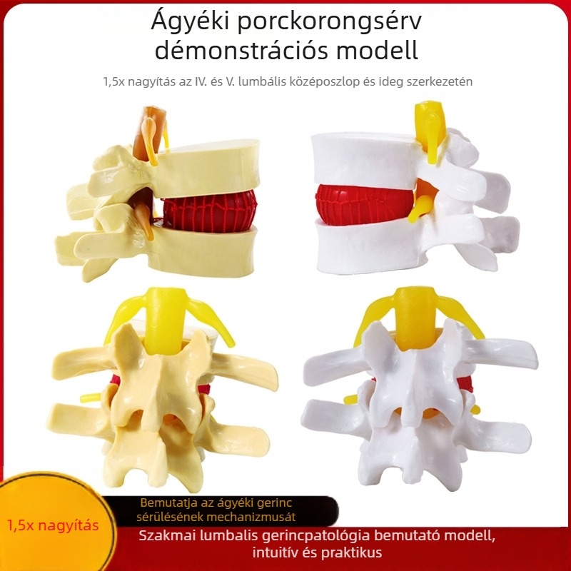 Csigolya közti korong modell, PVC anyagú oktatási anatómiai modell a lumbális patológiák bemutatására, Zhenghe River