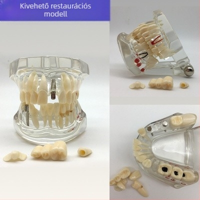 Fogorvosi oktatási modell patológiás rekonstrukcióval és standard implantátummal formával — helyi márka, nyomtatott logóval, fogászati oktatásra