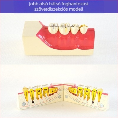 Fogorvosi oktatási modell patológiás rekonstrukcióval és standard implantátummal formával — helyi márka, nyomtatott logóval, fogászati oktatásra