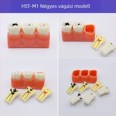 Fogorvosi oktatási modell patológiás rekonstrukcióval és standard implantátummal formával — helyi márka, nyomtatott logóval, fogászati oktatásra