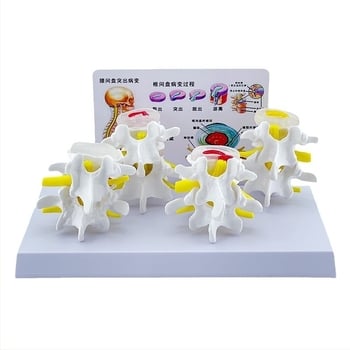 Blue Butterfly PVC négyrészes ágyéki gerinc modell: normál és patológiás csigolyák, discus patológia bemutató