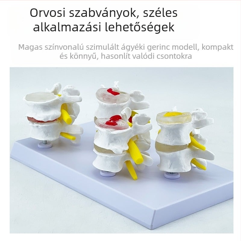 Blue Butterfly PVC négyrészes ágyéki gerinc modell: normál és patológiás csigolyák, discus patológia bemutató
