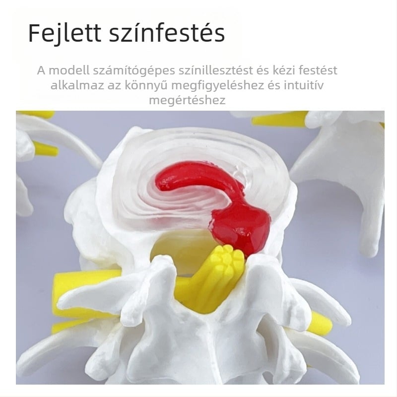 Blue Butterfly PVC négyrészes ágyéki gerinc modell: normál és patológiás csigolyák, discus patológia bemutató