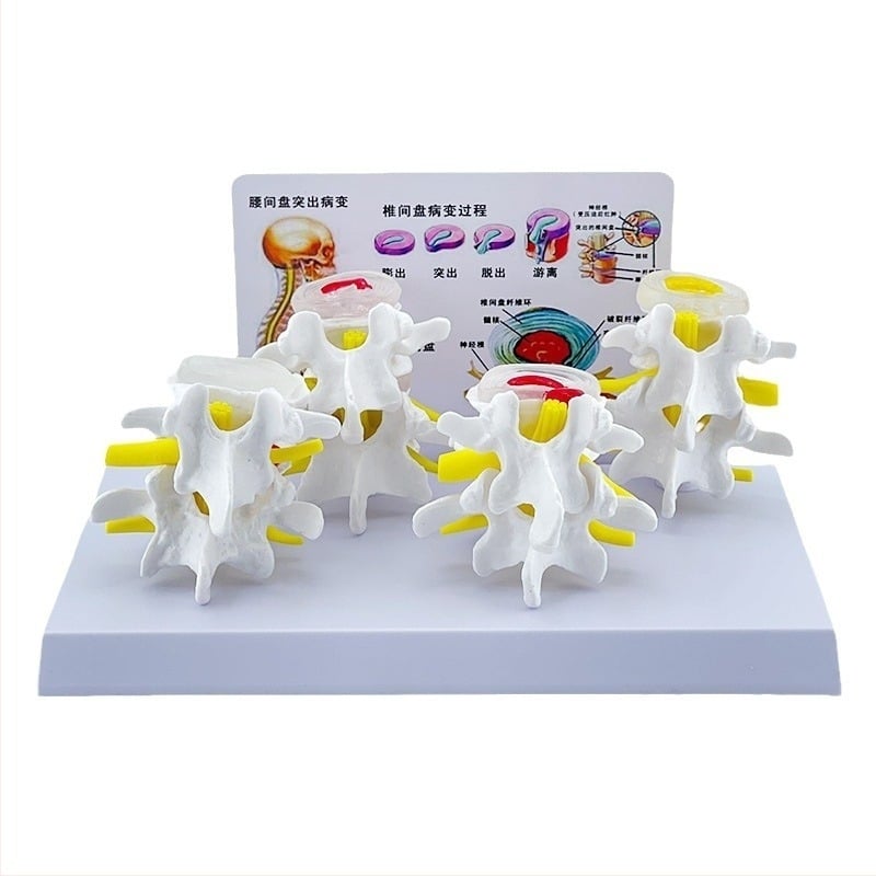 Blue Butterfly PVC négyrészes ágyéki gerinc modell: normál és patológiás csigolyák, discus patológia bemutató