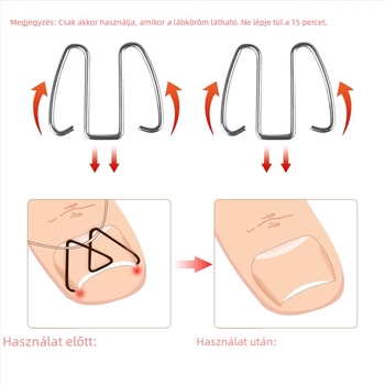 Beágyazódott köröm ortézis lábujjhoz; anyag: műanyag + rozsdamentes acél; nettó tartalom: 12.3; csomagolás: 1000 db; márka: Feet wake up