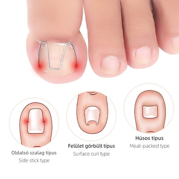 Beágyazódott köröm ortézis lábujjhoz; anyag: műanyag + rozsdamentes acél; nettó tartalom: 12.3; csomagolás: 1000 db; márka: Feet wake up