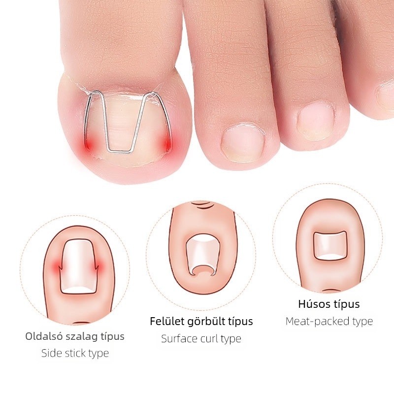 Beágyazódott köröm ortézis lábujjhoz; anyag: műanyag + rozsdamentes acél; nettó tartalom: 12.3; csomagolás: 1000 db; márka: Feet wake up