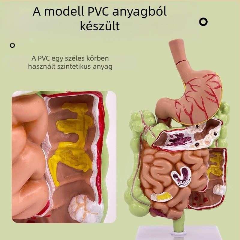 Emberi gyomor anatómiai modell — koronális metszet, patológiás gyomormodell perforációval, gasztroenterológiai képzés