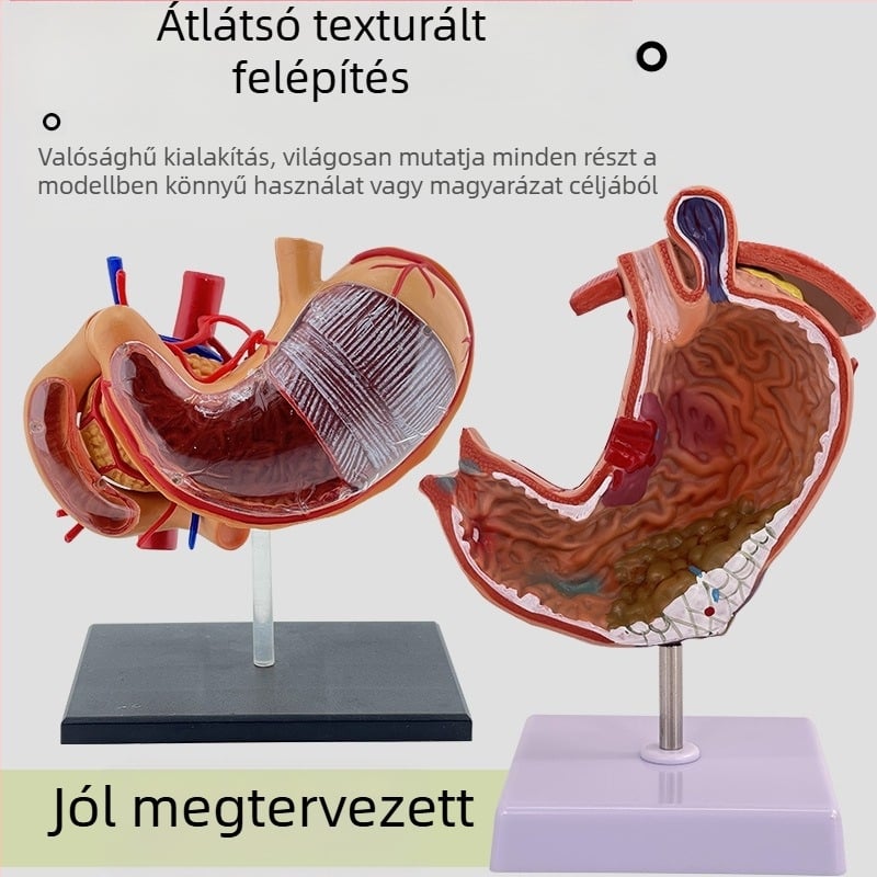 Emberi gyomor anatómiai modell — koronális metszet, patológiás gyomormodell perforációval, gasztroenterológiai képzés