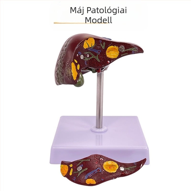 Nagyon realisztikus máj anatómiai modell, hepatobiliáris-pankreatikus-lép-duodenum rendszerrel és domborodó elváltozásokkal