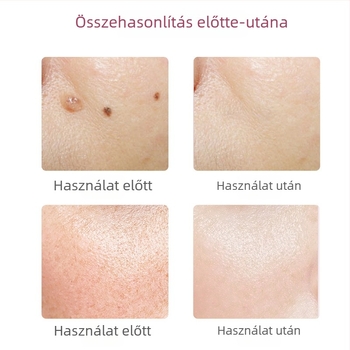 Szemölcs és szeplő eltávolító toll szalonban és otthon – lézeres folteltávolító készülék