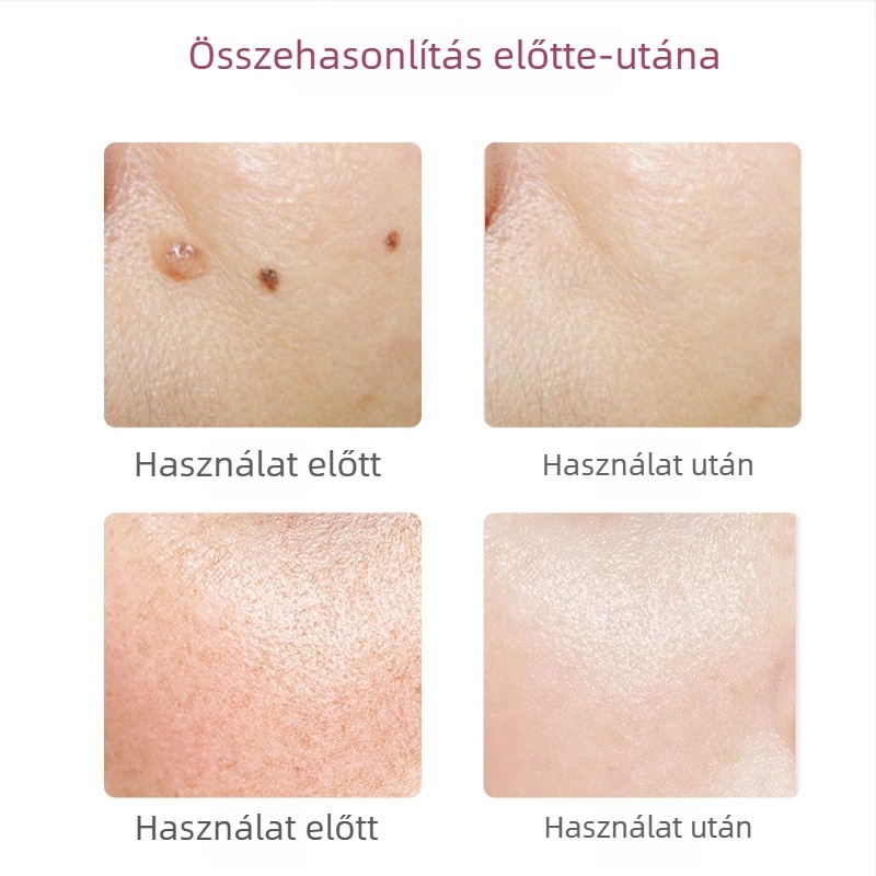 Szemölcs és szeplő eltávolító toll szalonban és otthon – lézeres folteltávolító készülék