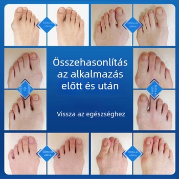 Állítható nagylábujj-korrekció hallux valgus esetén | Magas minőségű pamut anyag | Márka Junzukang | Minden évszakban használható