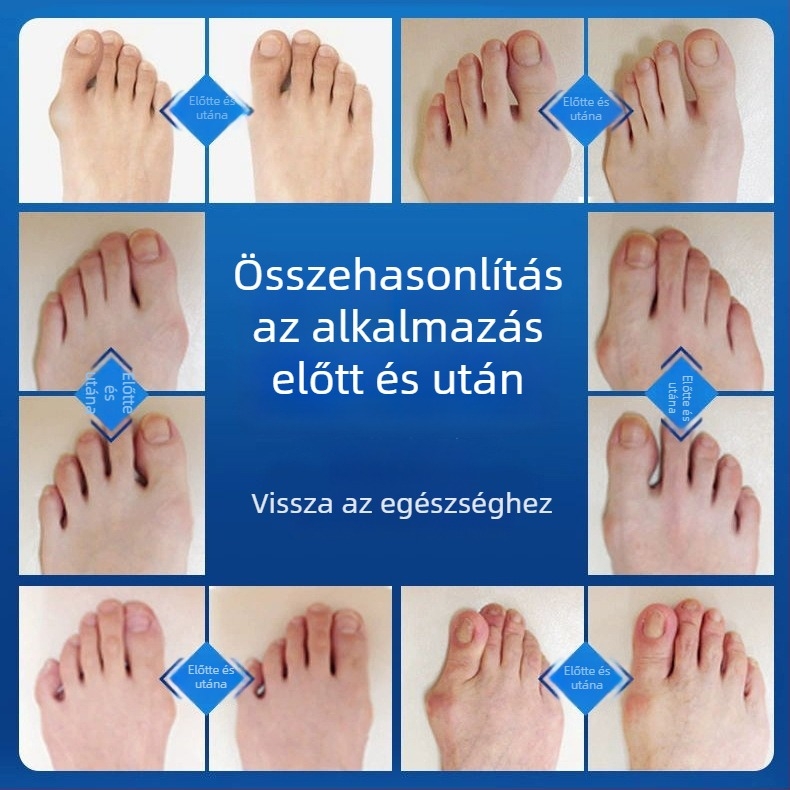 Állítható nagylábujj-korrekció hallux valgus esetén | Magas minőségű pamut anyag | Márka Junzukang | Minden évszakban használható