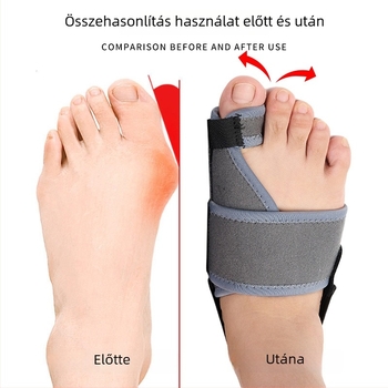 Nagy lábujj valgus korrigáló ortózis állítható pánttal, alumíniumlemez és ujjelválasztóval