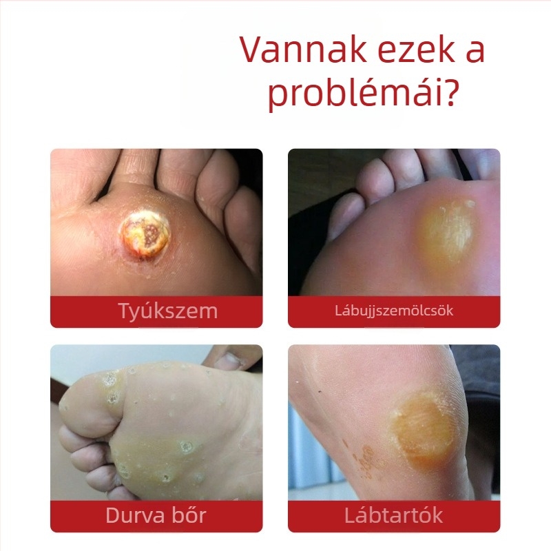 Lábápolási tapaszok tyúkszem és szemölcs eltávolítására, növényi antibakteriális hatással