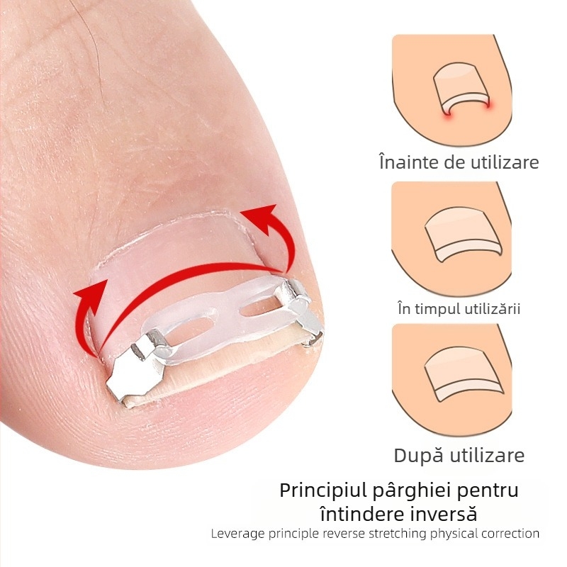 Dispozitiv ortopedic pentru unghii încarnate cu plasture de tracțiune pentru corectarea unghiilor încarnate