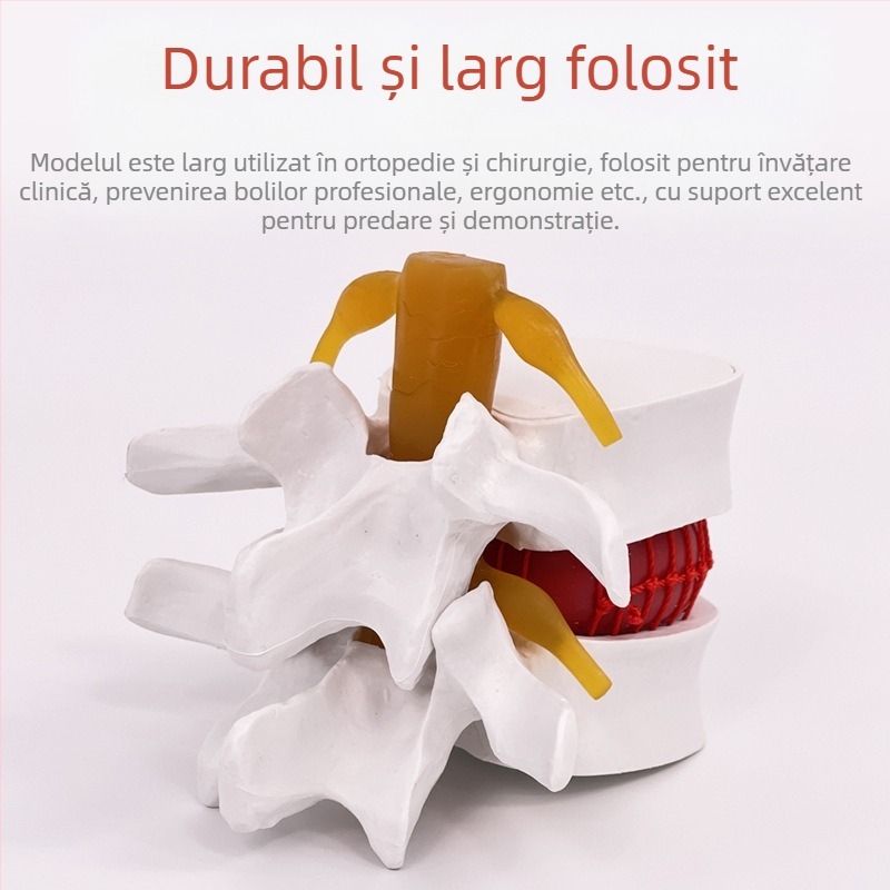 Model de coloană lombară pentru instruire medicală – demonstrație a comprimării discului lombar și patologie osoasă a coloanei vertebrale.