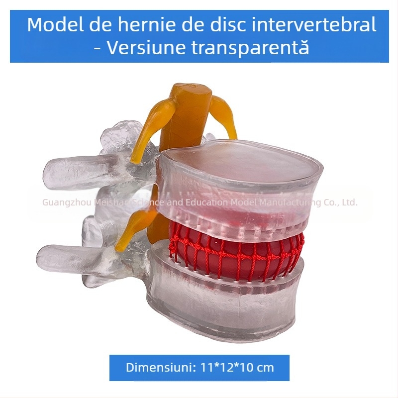 Model de coloană lombară pentru instruire medicală – demonstrație a comprimării discului lombar și patologie osoasă a coloanei vertebrale.