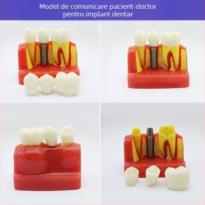 Model didactic stomatologic pentru patologie dentară și restaurare cu matriță standard de implant; marcă locală, siglă imprimată, destinat educației dentare