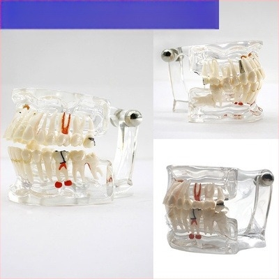 Model didactic stomatologic pentru patologie dentară și restaurare cu matriță standard de implant; marcă locală, siglă imprimată, destinat educației dentare