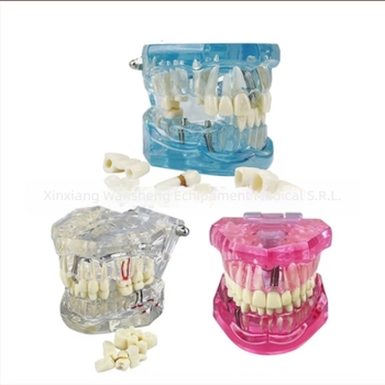 Model dentar cu patologie, model de punte și implant, detașabil, pentru adulți