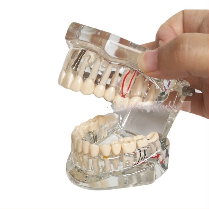 Model dentar cu patologie, model de punte și implant, detașabil, pentru adulți