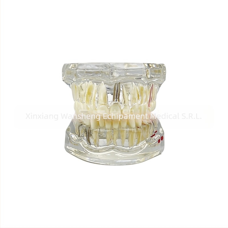 Model dentar cu patologie, model de punte și implant, detașabil, pentru adulți
