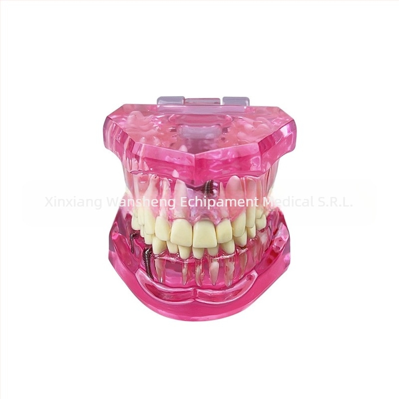 Model dentar cu patologie, model de punte și implant, detașabil, pentru adulți