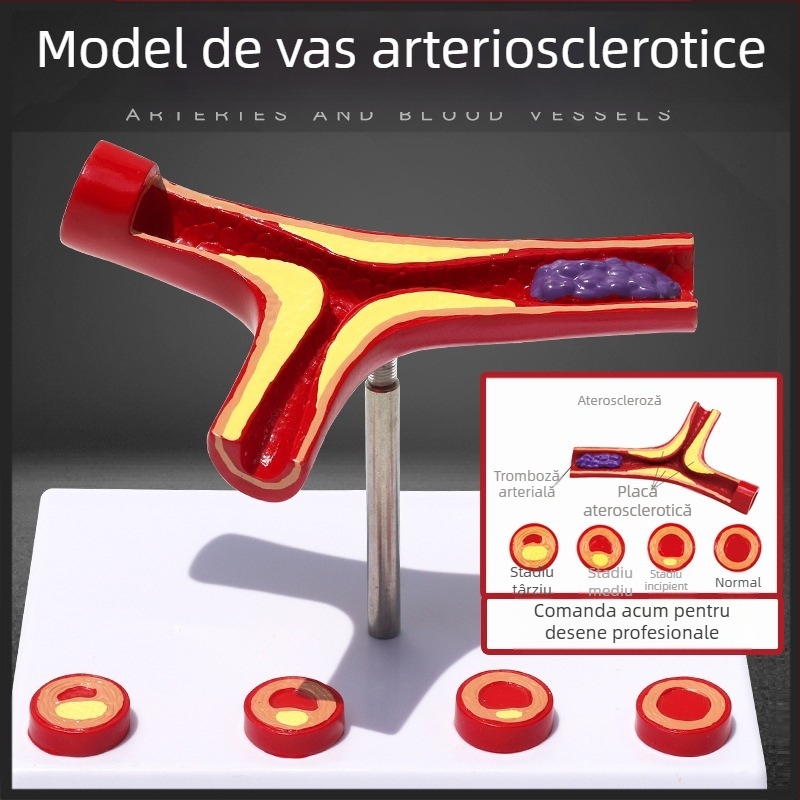 Model vascular dinamic – blocaj de densitate ridicată și tromb de placă – model educațional din plastic
