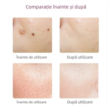 Creion pentru îndepărtarea alunițelor și petelor, pentru salon și uz casnic – dispozitiv laser pentru eliminarea petelor