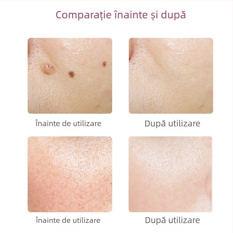 Creion pentru îndepărtarea alunițelor și petelor, pentru salon și uz casnic – dispozitiv laser pentru eliminarea petelor